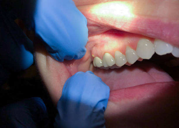 Best Dentist for Tooth Abscess  in Edgewater, NJ